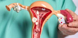 Março Amarelo aborda a importância de discutir a Endometriose